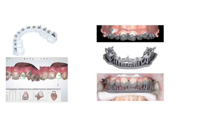 clear aligners 3D printed