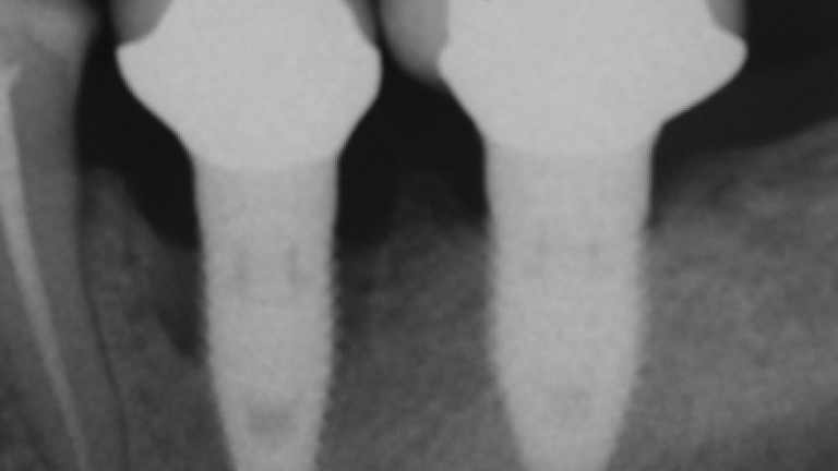 peri-implantitis progression (source: Wikipedia)