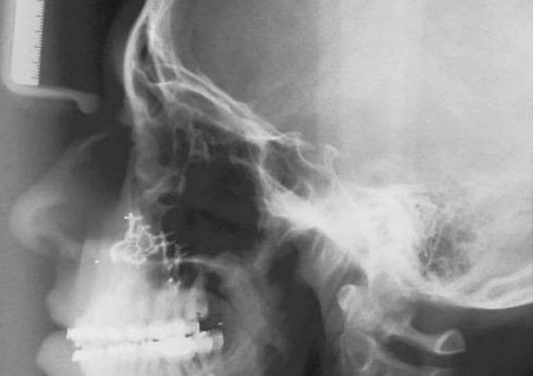 A radiograph of the jaw area. Image courtesy of Dr. Anders Nattestad.
