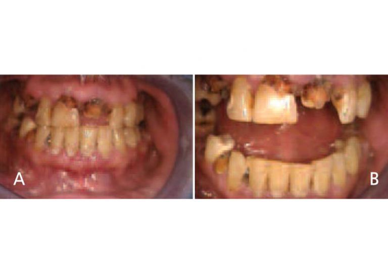 Oral manifestations in the advanced states of methamphetamine abuse include A) teeth broken off at the gingival margin; and B) grayish-brown dentition with enamel that is reduced to a soft leathery texture, along with gingivitis and acute periodontitis.