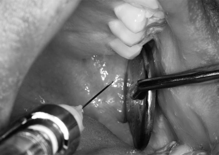 Delivery of mandibular block injection using modified retraction technique.