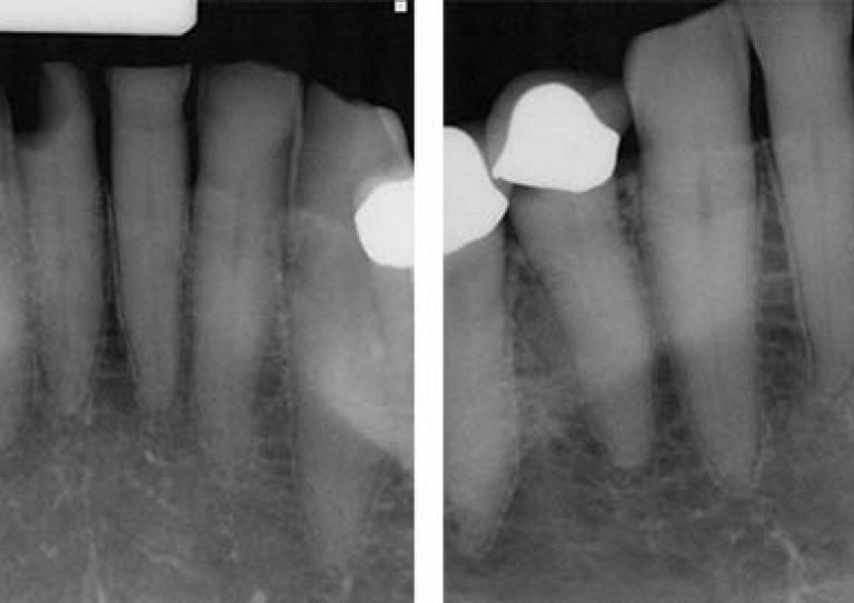 Radiograph of distal D3 approximal lesion on tooth #25. The technique known as SMART could help repair tooth damage and prevent caries without requiring multiple appointments.