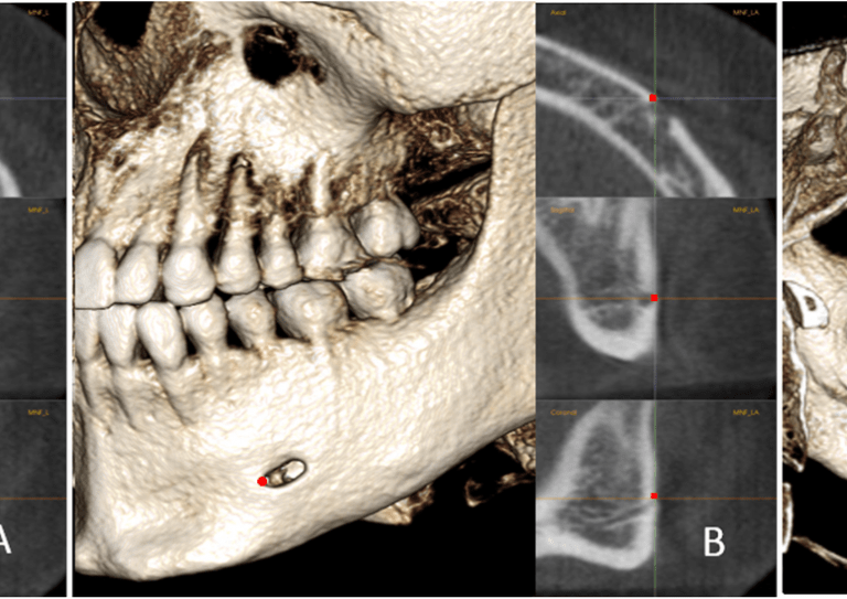 The positions of MF, MFA, and MdF on the left side: a, MF is located in center of the mental foramen; b, MFA is the most anterior point of the mental foramen; c, MdF is located in the center of the mandibular foramen. It is placed on the first slice where the canal shows a complete circle from superior to inferior