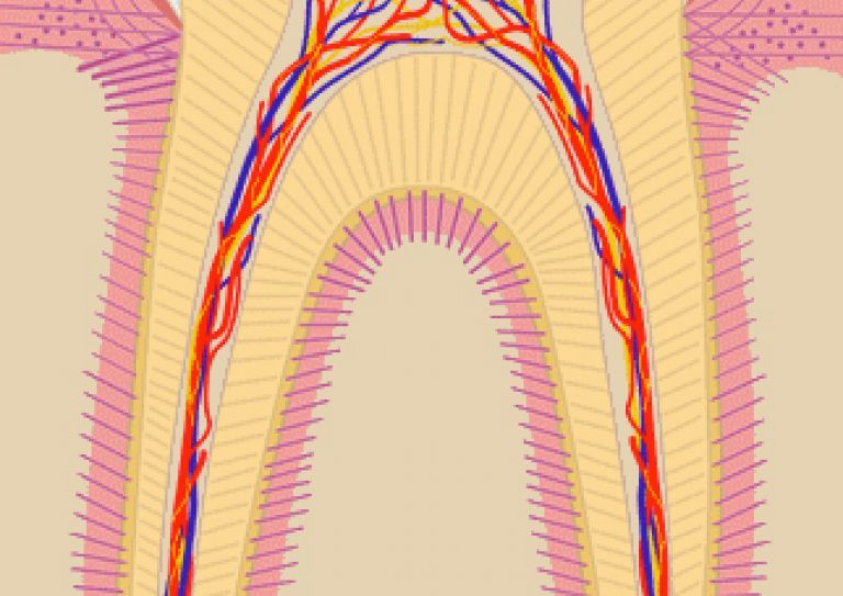 cross-section illustration of tooth with pulpitis