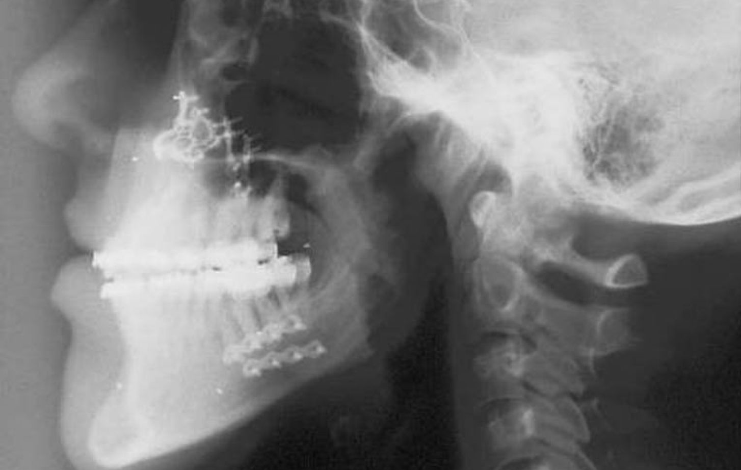 A radiograph of the jaw area. Image courtesy of Dr. Anders Nattestad.