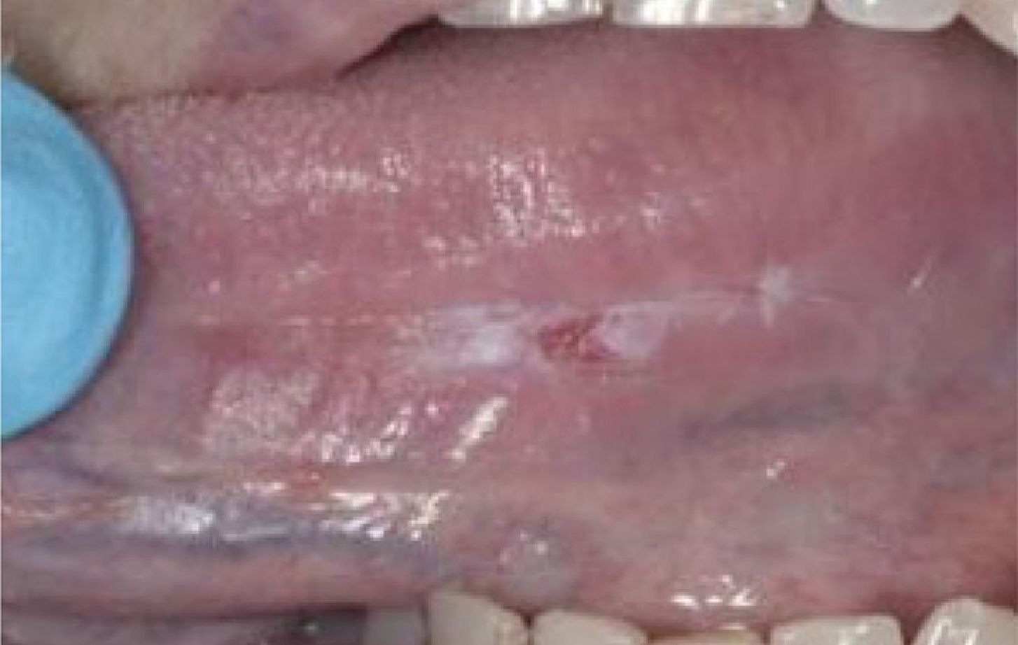 Leukoplakia. Most common precancerous lesion (89%: 618/695)