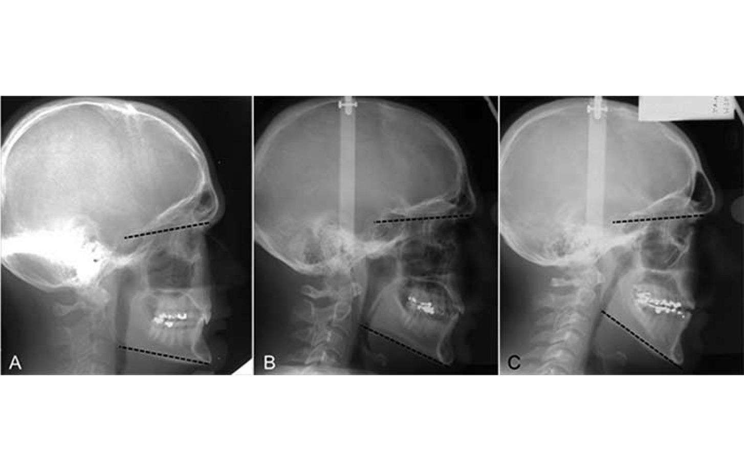 Lateral cephalograms demonstrating examples of hypo‐divergent (A), normo‐divergent (B) and hyper‐divergent (C) facial types.