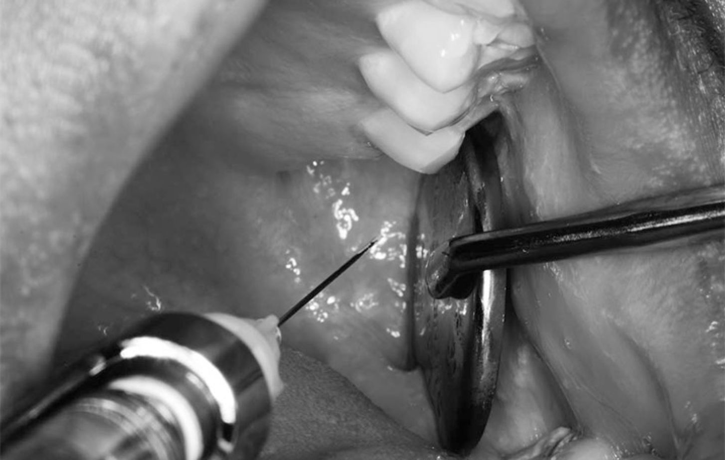 Delivery of mandibular block injection using modified retraction technique.