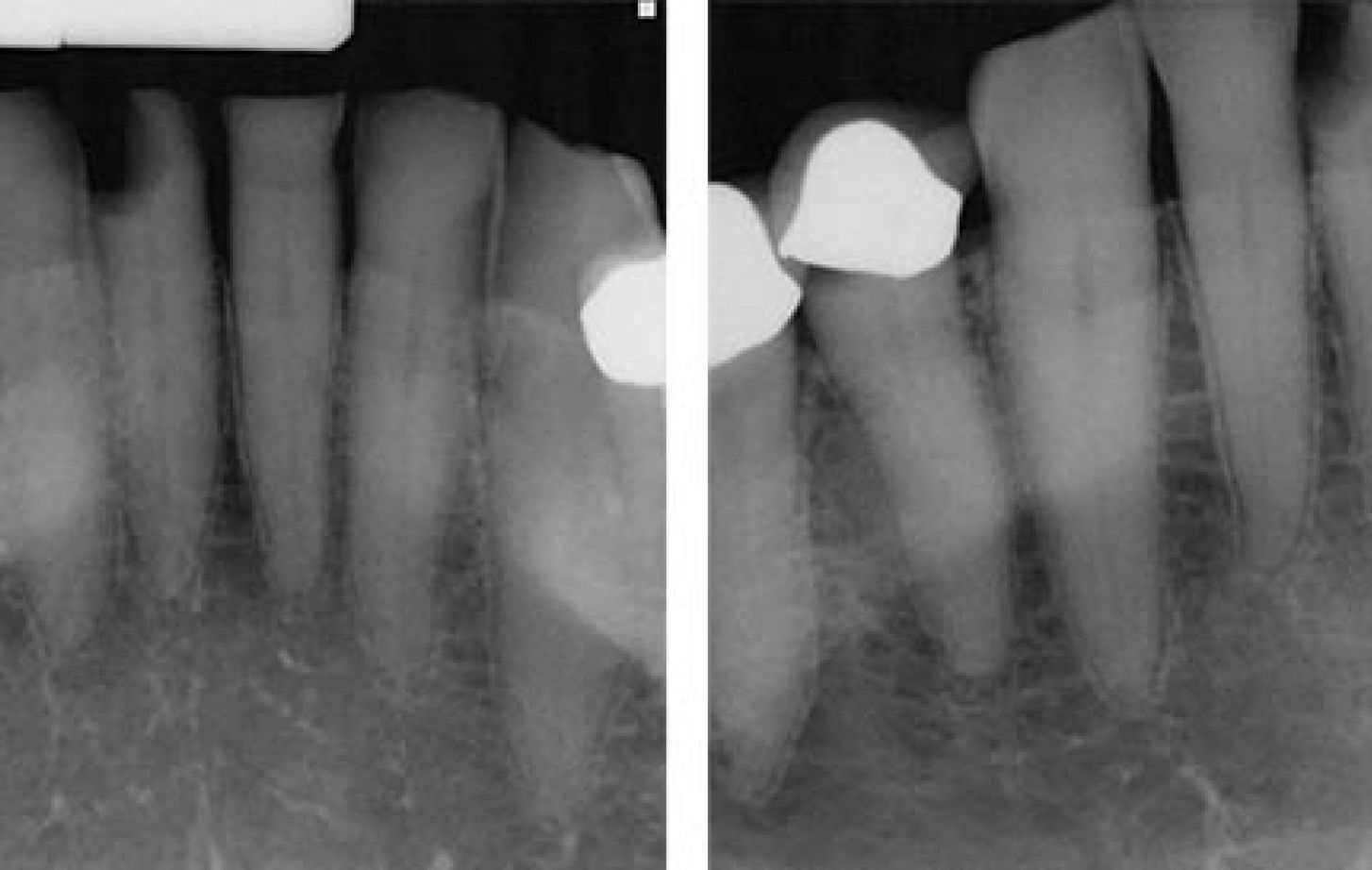 Radiograph of distal D3 approximal lesion on tooth #25. The technique known as SMART could help repair tooth damage and prevent caries without requiring multiple appointments.