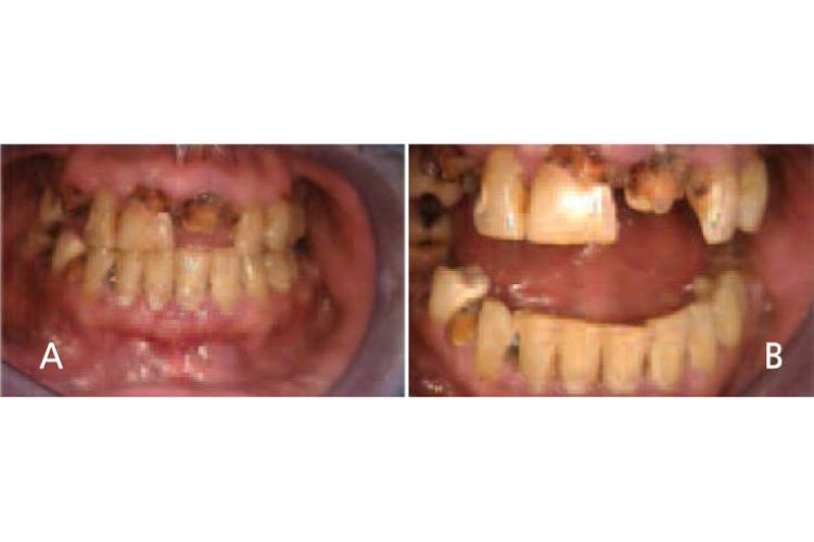 Oral manifestations in the advanced states of methamphetamine abuse include A) teeth broken off at the gingival margin; and B) grayish-brown dentition with enamel that is reduced to a soft leathery texture, along with gingivitis and acute periodontitis.