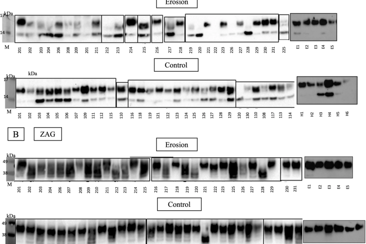 Caption: Immunoblots for (A) PIP and (B) ZAG proteins identified in saliva samples (E = erosion, H = healthy controls, M = protein marker)