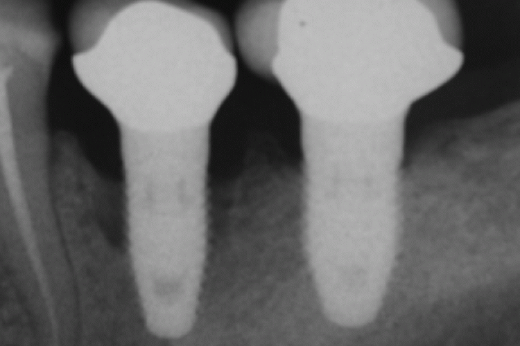 A radiograph two years after implant placement, then seven years later in a heavy smoker, demonstrating progression of bone loss due to peri-implantitis. Source: Wikipedia