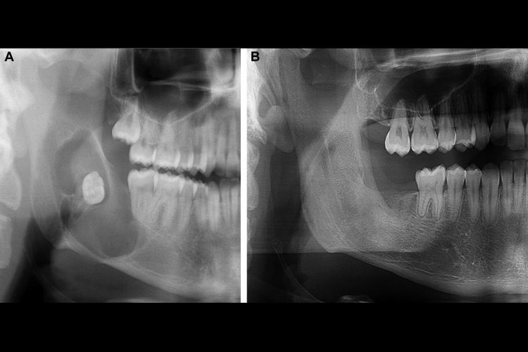 Figure 2. Representative example of odontogenic keratocyst treated with refined topical 5-fluorouracil technique. A, Preoperative Panorex radiograph showing a biopsy-confirmed odontogenic keratocyst involving the right mandibular body, and ramus. B, Six-month postoperative Panorex radiograph showing a well-healed, cyst-free right mandible treated with enucleation, peripheral ostectomy, and refined topical 5-fluorouracil technique