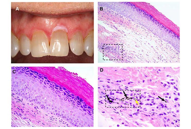 Fig. 1. (A) Clinical image showing a white lesion involving the facial marginal gingiva of tooth #9. (Courtesy of Dr. Reid Lester). (B) Representative photomicrograph showing hyperorthokeratosis and foreign material in the deep lamina propria (square) (hematoxylin and eosin [H&E]; original magnification £ 200). (C) High-power view of the same case shows that the epithelium exhibits dyskeratosis, cellular discohesion, and nuclear pleomorphism limited to the lower one-third of the epithelial thickness—mild dy