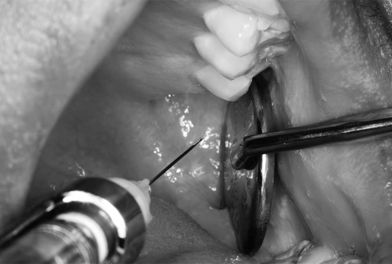 Delivery of mandibular block injection using modified retraction technique.