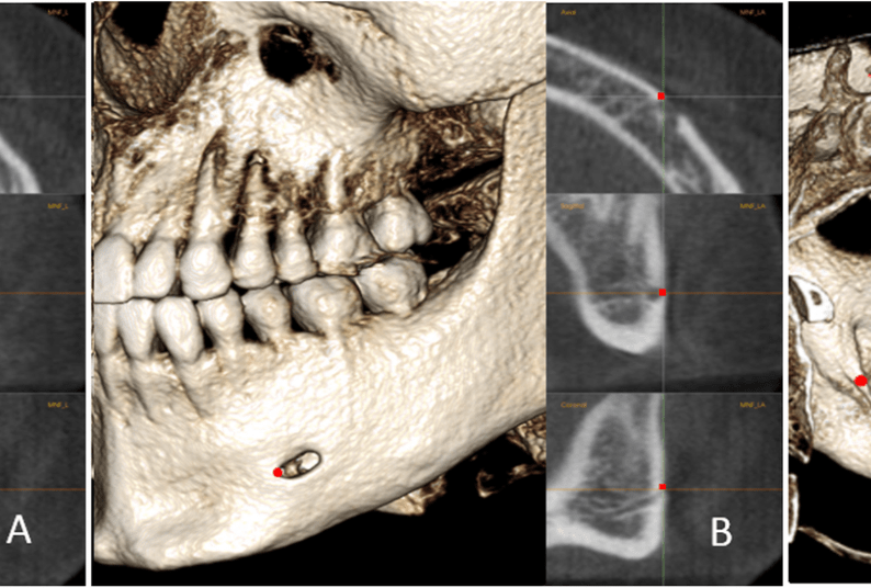 The positions of MF, MFA, and MdF on the left side: a, MF is located in center of the mental foramen; b, MFA is the most anterior point of the mental foramen; c, MdF is located in the center of the mandibular foramen. It is placed on the first slice where the canal shows a complete circle from superior to inferior