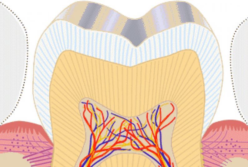 cross-section illustration of tooth with pulpitis