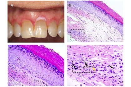 Fig. 1. (A) Clinical image showing a white lesion involving the facial marginal gingiva of tooth #9. (Courtesy of Dr. Reid Lester). (B) Representative photomicrograph showing hyperorthokeratosis and foreign material in the deep lamina propria (square) (hematoxylin and eosin [H&E]; original magnification £ 200). (C) High-power view of the same case shows that the epithelium exhibits dyskeratosis, cellular discohesion, and nuclear pleomorphism limited to the lower one-third of the epithelial thickness—mild dy