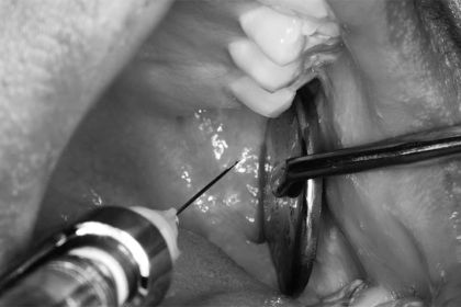 Delivery of mandibular block injection using modified retraction technique.