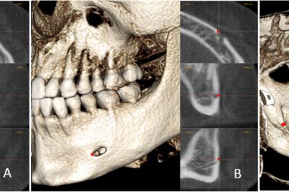 The positions of MF, MFA, and MdF on the left side: a, MF is located in center of the mental foramen; b, MFA is the most anterior point of the mental foramen; c, MdF is located in the center of the mandibular foramen. It is placed on the first slice where the canal shows a complete circle from superior to inferior