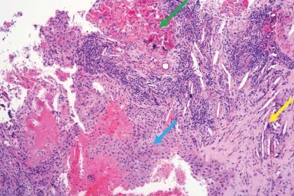The histologic examination shows an inflamed and distorted cyst at 40× magnification. The green arrow indicates the presence of Rushton bodies, the yellow arrow points to cholesterol clefts with multinucleated giant cells, and the blue arrow highlights an inflamed cystic lining with neutrophil exocytosis.