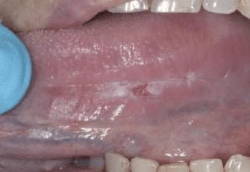 Detection Of Early Stage Oral Cancer Lesions A Survey Of California
