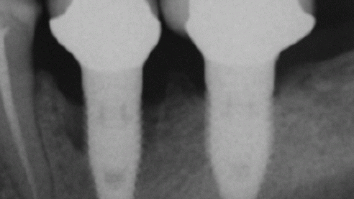 peri-implantitis progression (source: Wikipedia)